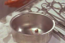 A bullet in a steel bowl on a table with other surgical instruments.
