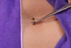 A bee being placed on Kelly's lower back