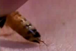 A bee stinger going into Kelly's skin