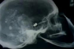 X-ray of a bullet inside of a skull